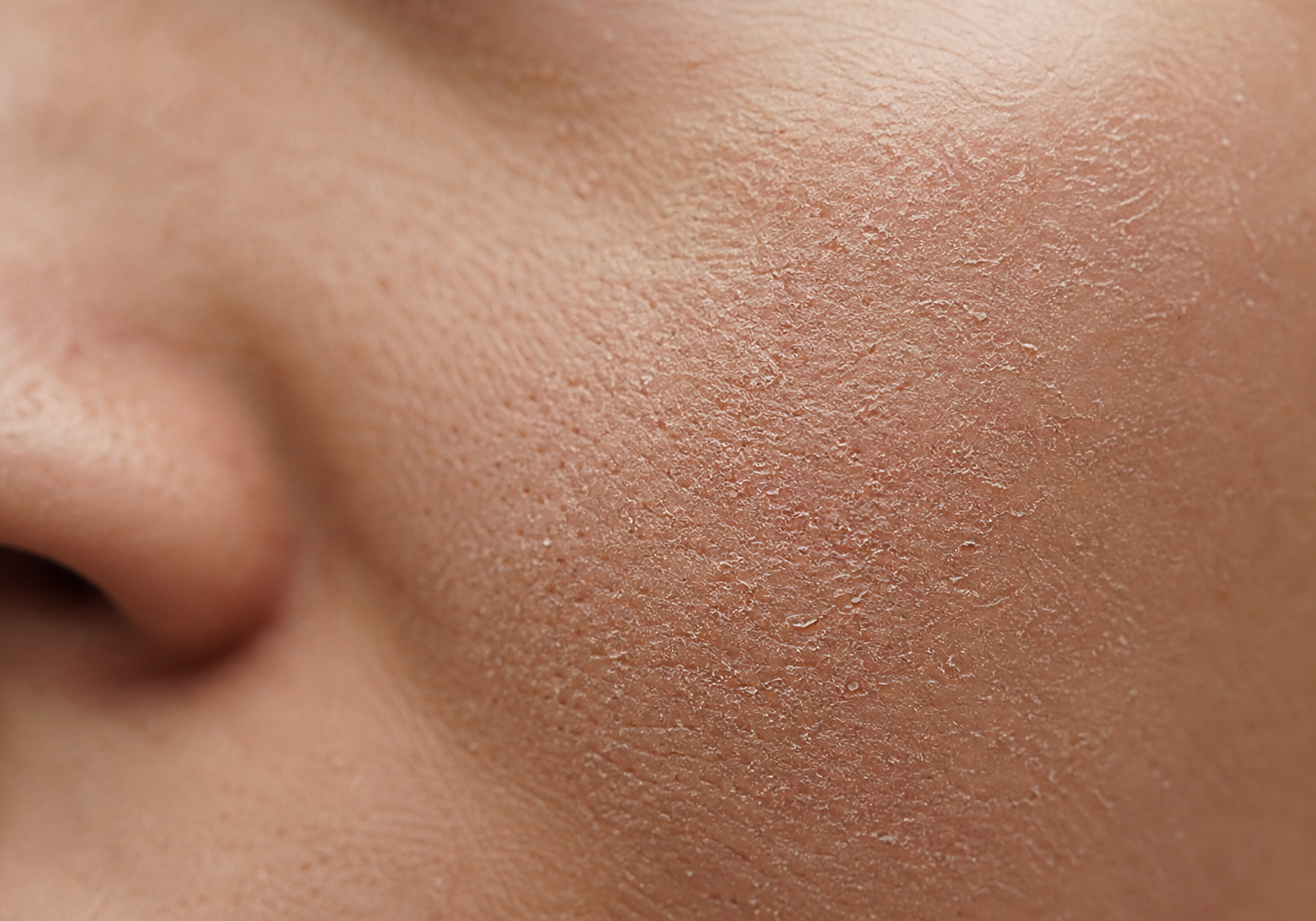 Dry Skin